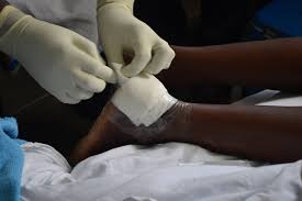 Experts Highlight Maggot Therapy in Chronic Wound Treatment.optimumnewsnow.com